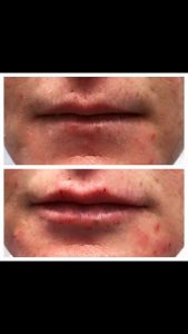 Facial rejuvenation after the 8 point lift using dermal fillers