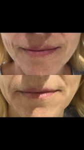 Small amount of dermal filler used to enhance lips for natural result